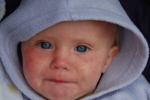 L’Istituto sanità  ciancia di morbillo. Ma a fare strage sono le infezioni