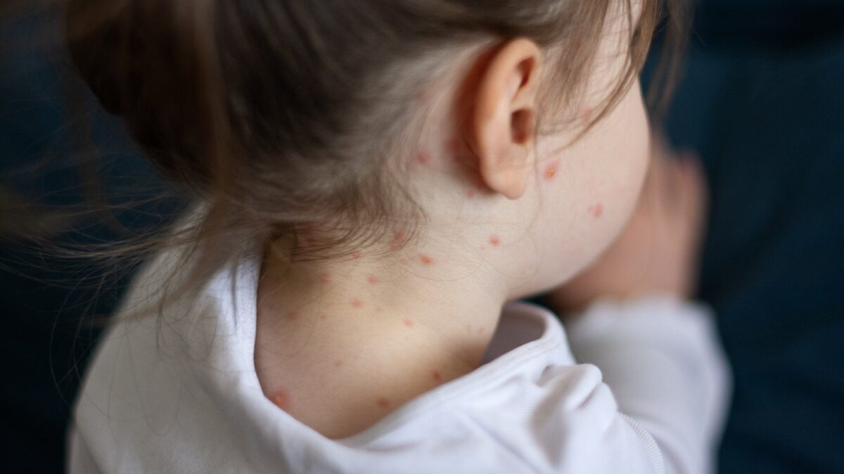 Non solo punture: contro il morbillo l’alimentazione è fondamentale